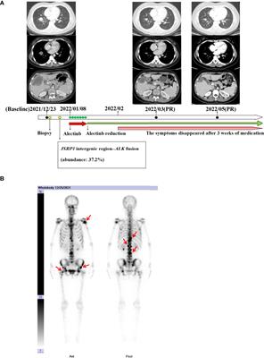 Case report: Novel junctional sarcoplasmic reticulum protein 1 intergenic region–anaplastic lymphoma kinase fusion in a patient with lung adenocarcinoma responds to alectinib